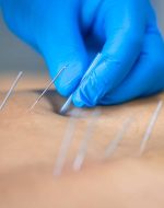 istockphoto-1725614059-612×612 Close up of a needle and hands of physiotherapist doing a dry needling in a physiotherapy center.